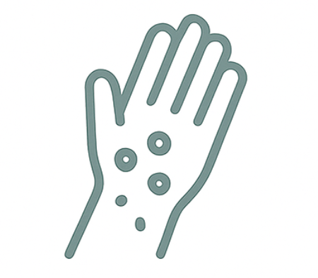 Eczema Treatment