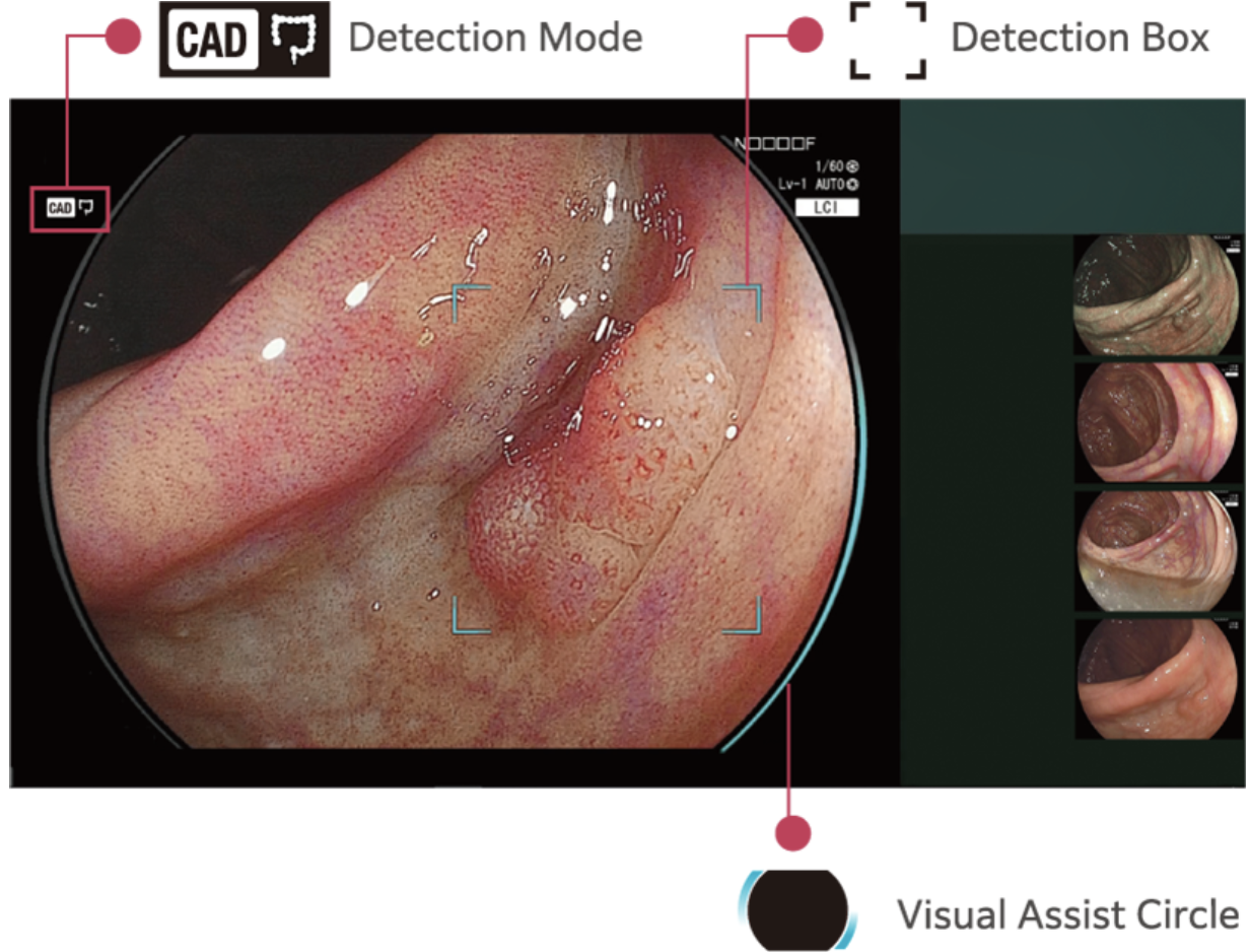 AI 智慧輔助內視鏡系統（CAD EYE）